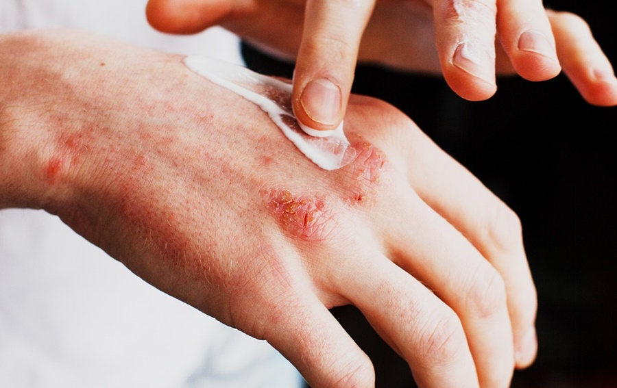 Dermatitis Ocupacional En Manos Cuidados Y Recomendaciones Para